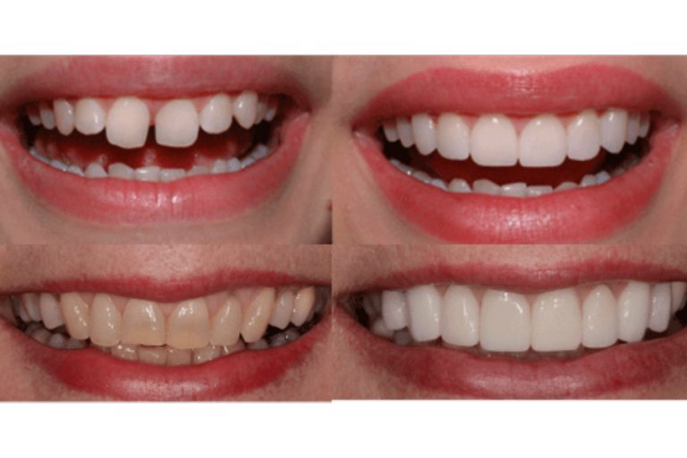 Useful Information About Dental Veneers | Body Projex