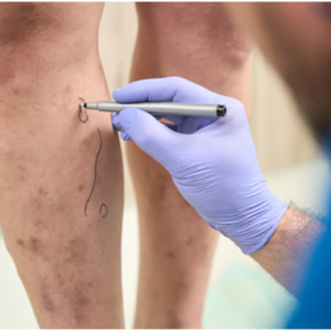 Sclerotherapy in Singapore