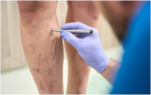 Sclerotherapy in Singapore